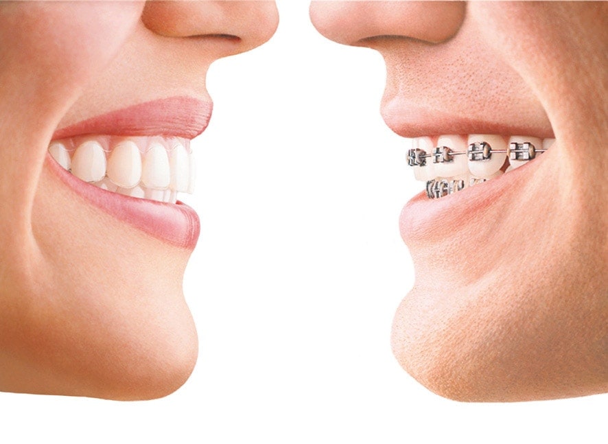 Invisalign clínica dr Calatayud