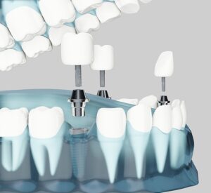 implantología clínica dr calatayud