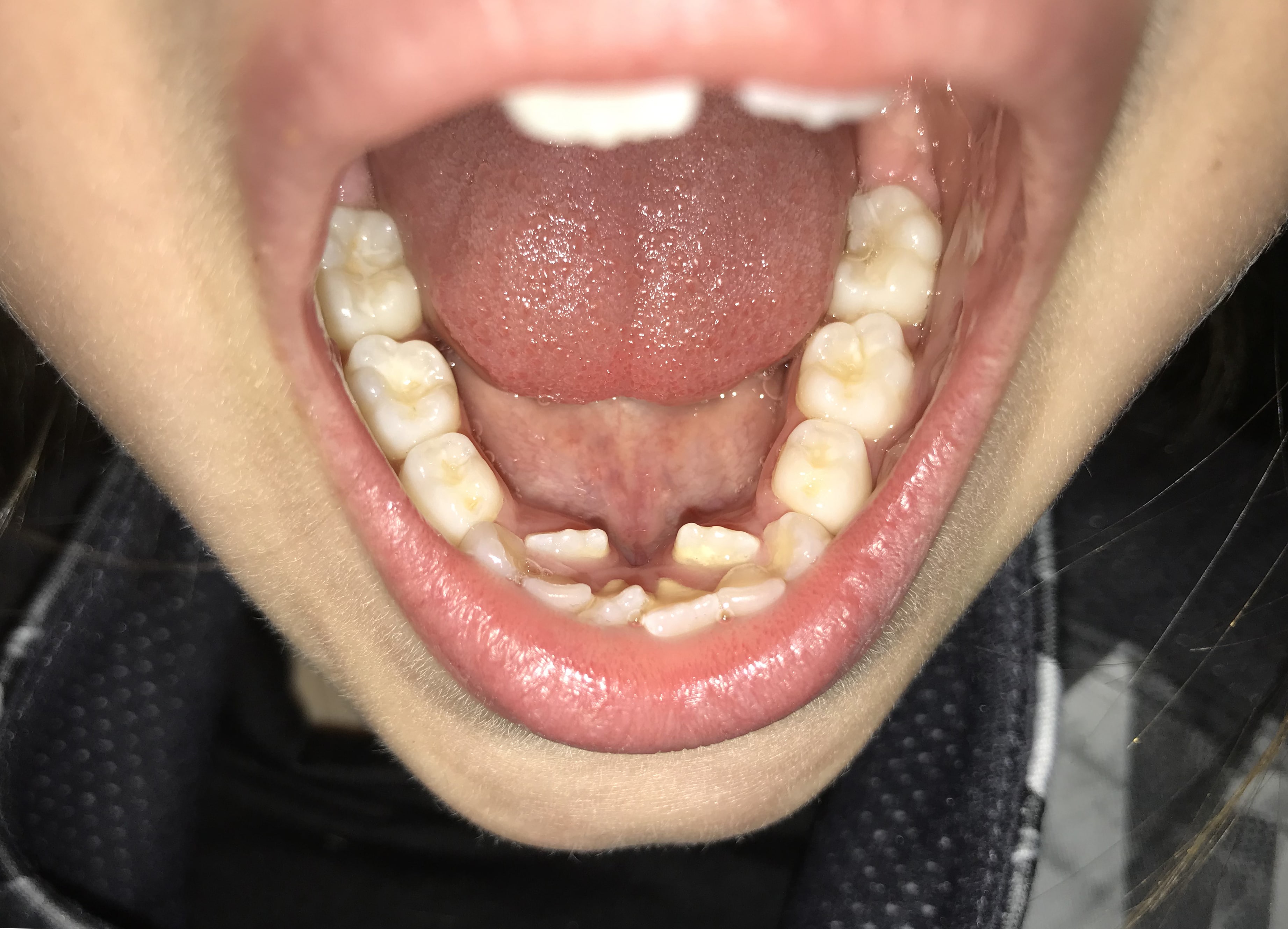 Porque No Salen Los Dientes Definitivos En Los Niños